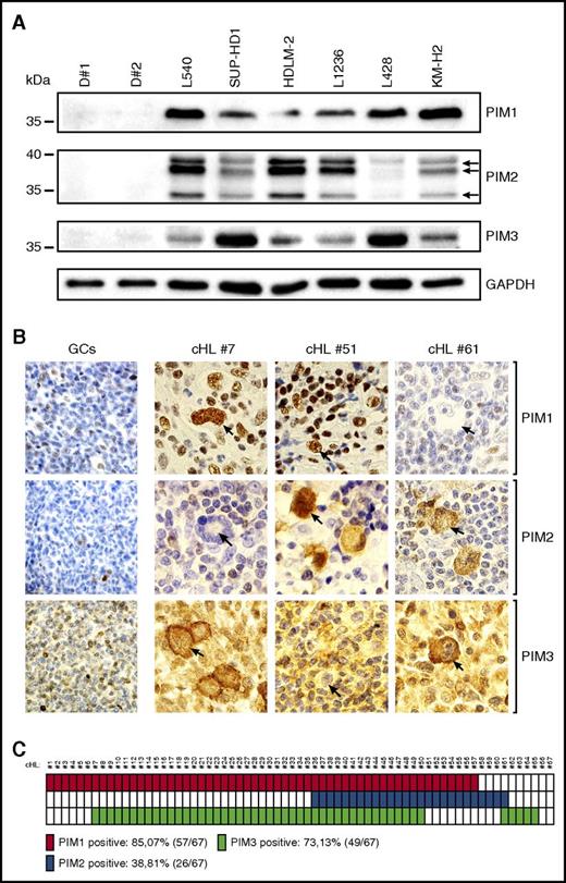 Figure 1. Primary and cultured RS cells express PIM1, PIM2, and PIM3 kinases. (A) Western blot analysis of PIM1, PIM2, and PIM3 expression in peripheral B cells isolated from healthy donors (D#1, D#2) and a panel of 6 cHL-derived RS cell lines. GAPDH served as a loading control. (B) Immunohistochemical analysis of PIM expression in reactive germinal centers and cHL samples. Shown are representative germinal centers (GCs) originating from follicular hyperplasia lymph node samples and cHL cases, double positive for PIM1 and PIM3 (#7), PIM1 and PIM2 (#51), and PIM2 and PIM3 (#61). RS cells are indicated with arrows. Original magnification was ×600. (C) Summary of the immunohistochemical analysis of PIM expression performed in a panel of 67 patients with cHL. Solid blocks, positive cases; open blocks, negative cases.