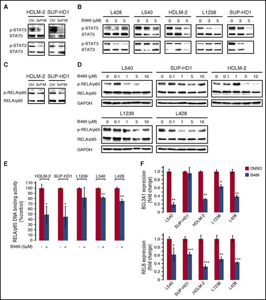 Figure 5. PIM inhibition downregulates NFκB and STAT3/5 activity in cHL-derived cell lines. (A) PIM1/2/3 depletion decreases STAT3/5 activity in RS cells. Cells were transfected with a nontargeting siRNA (control, Ctrl) or with a siRNA cocktail targeting all 3 PIM kinases (3×PIM). Thereafter, cells were cultured for 4 days, and phospho-STAT5 (Y694) and phospho-STAT3 (Y705) protein levels were assessed by immunoblotting. Densitometric quantifications of band intensities (p-STAT5 and p-STAT3 normalized to STAT5 and STAT3, respectively) are indicated above the lanes. (B) SEL24-B489 decreases STAT3/5 activity in RS cells. Cells were incubated for 24 hours with 3-5 µM SEL24-B489 or DMSO alone, harvested, and lysed. Phospho-STAT5 (Y694) phospho-STAT3 (Y705) levels were assessed by immunoblotting. Densitometric quantifications of band intensities are shown in supplemental Table 7. (C) PIM1/2/3 depletion decreases PIM-specific RELA/p65-S276 phosphorylation in RS cells. Cells were transfected with a nontargeting siRNA (control, Ctrl) or with a siRNA cocktail targeting all 3 PIM kinases (3×PIM). Thereafter, cells were cultured for 4 days, and phospho-RELA/p65 (S276) levels were assessed by immunoblotting. Densitometric quantifications of band intensities (p-RELA/p65 normalized to RELA/p65) are indicated above the lanes. (D) SEL24-B489 decreases RELA/p65 S276 phosphorylation in RS cells. Cells were incubated for 4 hours with DMSO alone or with 0.1-10 µM SEL24-B489, harvested, and lysed. The abundance of phospho-RELA/p65 (S276) was assessed by immunoblotting. GAPDH served as a loading control. Densitometric quantifications of band intensities are shown in supplemental Table 8. (E) SEL24-B489 reduces DNA binding activity of the RELA-containing NFκB complexes. RS cells were incubated either with DMSO alone or SEL24-B489 (5 µM) for 24 hours, lysed, and subjected to TransAM DNA binding assay, using the RELA-specific antibody. (F) PIM inhibition in cHL cell lines decreased NFκB-dependent gene expression. Cells were incubated with DMSO alone or with SEL24-B489 (3 µM) for 24 hours. Thereafter, expression of BCL2A1 and RELB was assessed by qPCR. Raw ΔCT values are shown in supplemental Figure 12. P values were determined using the 2-sided Gosset’s t-test: *P < .05; **P < .01; ***P < .001. Data in A-F are representative of 3 independent experiments.
