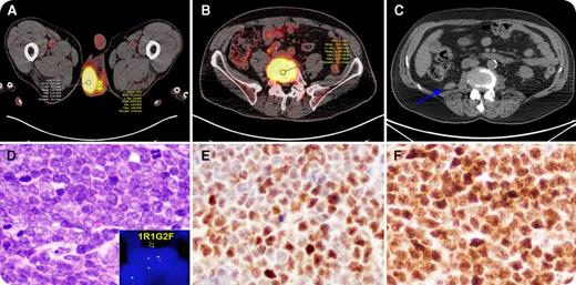 A 74-year-old man presented with bilateral testicular masses and back pain. A positron emission tomography scan showed increased metabolic activity in bilateral testes (panel A; ROI, region of interest; SUV, standardized uptake value), and lytic lesions in the left pubic symphysis and L5 vertebral body (panel B). Bilateral orchidectomy and L5 vertebral specimens were characterized by sheets of medium-sized blastic cells (panel D; original magnification ×400, hematoxylin and eosin stain) positive for PAX5 (panel E; original magnification ×400), terminal deoxynucleotidyltransferase (panel F; original magnification ×400), CD10, and CD34 by immunohistochemistry. Fluorescence in situ hybridization (FISH) analyses performed on both testicular and L5 vertebral specimens revealed BCR-ABL1 rearrangement (panel D, insert). Bone marrow was negative for acute leukemia by morphology and flow cytometry. Results of chromosomal and FISH analyses for BCR-ABL1 were negative. Reverse transcription polymerase chain reaction (RT-PCR) analysis revealed 0.48% of e1a2 BCR-ABL1 fusion transcript. The patient was diagnosed with Philadelphia chromosome–positive B-lymphoblastic lymphoma (B-LBL), treated with hyper–cyclophosphamide, vincristine, doxorubicin plus dasatinib and achieved complete remission. / Four years later, the patient presented with a right kidney mass (panel C, arrow). A biopsy revealed recurrent B-LBL. Again, bone marrow analysis was negative for acute leukemia by morphology and flow cytometry and was negative for BCR-ABL1 by RT-PCR. The patient died 1 week later. This is the first case of Philadelphia chromosome–positive B-LBL involving the genitourinary system and bone as isolated tissue masses at both initial presentation and relapse.
