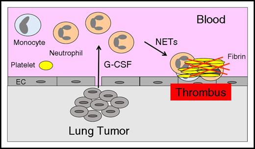 Figure 1. Neutrophilia increases thrombosis in lung cancer. Tumor-derived G-CSF leads to increased levels of neutrophils, and these neutrophils release NETs that increase thrombosis in patients with lung cancer. EC, endothelial cell.