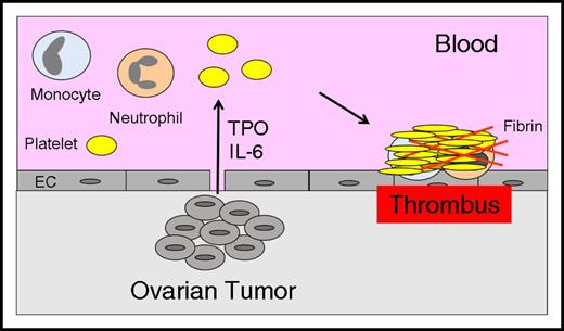 Figure 2. Thrombocytosis increases thrombosis in ovarian cancer. Tumor-derived IL-6 stimulates hepatocytes to express thrombopoietin (TPO), which increases platelet production and enhances thrombosis in patients with ovarian cancer.