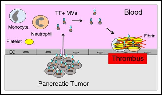 Figure 3. Tumor-derived TF+ MVs trigger thrombosis in pancreatic cancer. Pancreatic tumor cells release TF+ MVs into the circulation that trigger thrombosis in patients with pancreatic cancer.