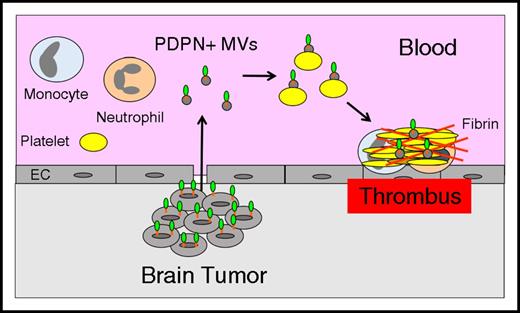Figure 4. Tumor-derived, PDPN+ MVs trigger thrombosis in brain cancer. Brain tumor cells may release PDPN+ MVs that activate circulating platelets and increase thrombosis in patients with brain cancer.