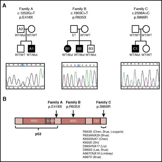Figure 1. Genetics and pedigrees of families with NFKB2 mutations. (A) Pedigrees and Sanger sequencing of families with NFKB2 mutations. Mutation status of NFKB2 c.1252G>T for family A, NFKB2 c.1903C>T for family B, and NFKB2 c.2596A>C for family C are indicated for each individual. Pedigree with those affected shown in black filled symbols. (B) Schematic of NF-κB2 with the Rel homology domain (RHD), nuclear localization signal (N), glycin-rich region (GR), ankyrin repeat domain (ARD), and death domain (DD). The amino acid sequence and location for affected individuals are shown with arrow.