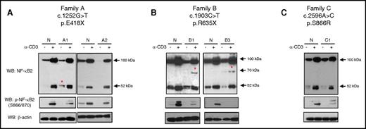 Figure 2. NF-κB2 protein expression in PBMCs. (A-C) Immunoblot of wild-type and mutant NF-κB2 in PBMCs from healthy normal control and patients. Total PBMCs were treated with α-CD3 to stimulated NF-κB2 pathway for 48 hours. Cell lysates were prepared and analyzed for phosphorylation of p100 and for full-length (p100) and active form (p52), and mutant expression by western blotting. Immunoblotting of β-actin was used as a loading control. Red asterisks indicate mutant form of NF-κB2 in patient cells. Due to the similar size between mutant E418X and active form of NF-κB2 (p52), it was difficult to discriminated mutant (E418X) from active form of NF-κB2 in stimulated condition in patient A1.