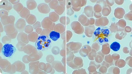 A 5-day-old boy was brought to the emergency room with a history of fever, lethargy, poor feeding, and yellowish coloration of skin. On examination, the child was febrile, hypotensive, and deeply jaundiced. Laboratory tests showed a total bilirubin level of 764.7 µmol/L (44.7 mg/dL) and direct bilirubin of 37 µmol/L. Hemoglobin was 178 g/L, white cell count 26.1 × 109/L, neutrophils 16.1 × 109/L, lymphocytes 5.8 × 109/L, and monocytes 3.0 × 109/L. There was no blood group incompatibility with mother. The child was admitted to the pediatric intensive care unit and given IV fluids, broad-spectrum antibiotics, along with double-volume exchange transfusion and intensive phototherapy. Blood culture grew Escherichia coli; therefore, a diagnosis of hyperbilirubinemia secondary to E coli sepsis was made. The peripheral blood smears made from EDTA-anticoagulated blood showed golden-brown refractile crystals in the cytoplasm of neutrophils. The crystals were mostly rhomboid to rectangular (panel A; original magnification ×1000, Wright-Giemsa stain) in shape; however, needlelike crystals (panel B; original magnification ×1000, Wright-Giemsa stain) were also seen in occasional neutrophils. / Bilirubin crystals are occasionally seen in neutrophils from neonates and children with marked hyperbilirubinemia. These bilirubin crystals are more commonly found in septicemia than with hemolytic disease of the newborn. The crystal formation is believed to be an in vitro phenomenon because it is specific to blood samples collected in EDTA.