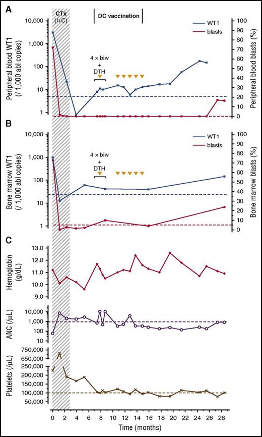 Figure 2. SD in patient UPN33 during (arrows) and after WT1/DC vaccination. WT1 transcript levels (determined by the Ipsogen WT1 ProfileQuant Kit) in blood (A) and bone marrow (B) were above background (indicated by the dotted blue line) but remained stable, and the bone marrow blast count normalized (normal value indicated by the dotted pink line). (C) Blood values showed pancytopenia at the start of DC vaccination but a normal hemoglobin level (without transfusions) at the end of the SD period (at 19 months); neutropenia was treated with granulocyte colony-stimulating factor. 4 × biw + DTH, period of the first 4 biweekly WT1/DC vaccinations and DTH; ANC, absolute neutrophil count; CTx (I + C), polychemotherapy (induction + 2 consolidations).