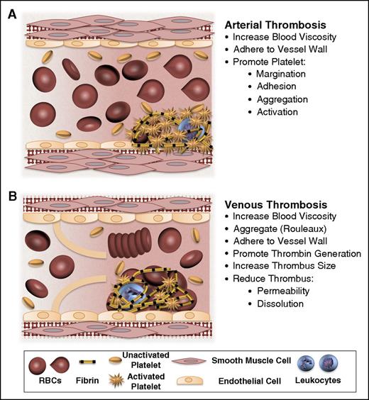 Figure 1. Potential contributions of normal and abnormal RBCs to arterial and venous thrombosis/thromboembolism. (A) Arterial thrombi arise in vessels with high shear rates, which promotes the rapid formation of platelet-rich thrombi. During arterial thrombosis, RBCs promote platelet margination, increase platelet-thrombus interactions, and enhance platelet adhesion and activation. Although RBCs increase blood viscosity, this effect is lessened in arteries by high shear-induced shape change. (B) Venous thrombi form slowly in stasis or low flow (frequently in venous valve pockets) and are RBC and fibrin rich. In veins, RBC aggregation into stacked rouleaux structures increases blood viscosity. RBCs can also directly or indirectly adhere to the vessel wall and may contribute to thrombin generation within thrombi. Once incorporated into venous thrombi, RBCs increase thrombus size and reduce thrombus permeability and susceptibility to lysis. In disease states, abnormal RBCs and RBC-derived microvesicles may also adhere to the endothelium or extracellular matrix, activate platelets and other cells, and enhance local thrombin generation during thrombosis.