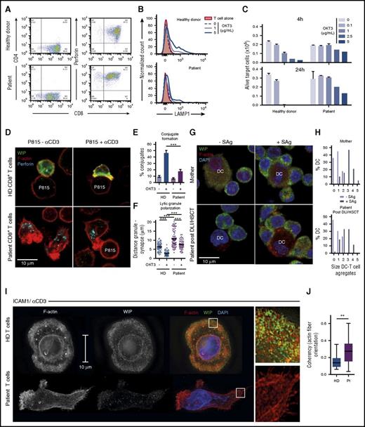 Figure 2. WIP controls CD8+ T lymphocyte cytotoxicity and actin meshwork ultrastructure at the IS. (A) Flow cytometry analysis of CD4, CD8, and perforin expression in purified CD8+ T cells expanded from a healthy donor and the WIP-deficient patient. (B) LAMP-1 expression at the surface of CD8+ T cells upon incubation with P815 cells coated with the indicated concentrations of αCD3 antibody. (C) CD8+ T-cell cytotoxic activity assessed by counting the residual alive P815 target cells after 4 or 24 hours. (D) Representative pictures of healthy donor CD8+ T cells and patient CD8+ T cells forming conjugates with P815 cells coated or not with αCD3 antibody. Fixed conjugates were stained for WIP, F-actin, and perforin. (E) The proportion of T cells forming a synaptic contact with P815 cells was assessed from confocal images. At least 300 cells were analyzed per condition. (F) The distance from lytic granules to the T cell–P815 cell interface was calculated from confocal images. (G) Representative pictures of conjugates formed between T cells and DCs precoated or not with a cocktail of superantigens. Cells were isolated from the blood of the mother or the patient post-DLI/HSCT, as indicated. Fixed conjugates were stained for WIP, F-actin, and 4′,6-diamidino-2-phenylindole (DAPI). (H) The distribution of the number of T cells captured per DC is represented for each indicated condition. (I) Reconstructed structured illumination microscopy images of healthy donor and patient CD8+ T cells spreading over ICAM-1/αCD3. Staining for WIP, F-actin, and DAPI is shown for a ventral section of 110-nm thickness. Zoomed areas reveal actin meshwork architecture and WIP distribution. (J) The quantification of actin fiber coherency corresponds to the analysis of 20 zoomed areas per condition. DC, dendritic cell. HD, healthy donor. SAg, super-antigens. *P < .05, **P < .01, ***P < .001.