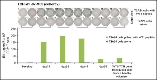 Figure 4. Reactivity to WT1 peptide in PBMCs after the TCR-T cells transfer. PBMCs collected from TCR-WT-07-M03 in cohort 2, before and after transfer of the TCR-T cells. CD8+ T-cells were selected, stimulated in vitro with WT1 peptide, and subjected to an ELISPOT assay. The target T cells were T2A24 cells pulsed with WT1 peptide. T2A24 cells alone were used as control targets, and WT1-specific TCR-T cells from a healthy volunteer were used as positive effector cells.