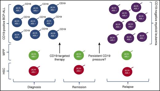 Potential mechanism of relapse after CD19-targeted immunotherapy in patients with Ph+ ALL and BCR-ABL fusion in the CD19+ leukemic compartment, as well as multipotent progenitor (MPP) cells and/or other hematopeietic stem cell (HSC) progenitor compartments. With anti-CD19 immune pressure and eradication of CD19+ leukemia, CD19– myeloid phenotype leukemia can emerge, likely redifferentiated from the progenitor populations. Whether persistence of anti-CD19 pressure will increase the likelihood of this mechanism of resistance remains a question.