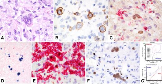 A 66-year-old man was diagnosed with chronic lymphocytic leukemia/small lymphocytic lymphoma (CLL/SLL) in 2006, observed until 2011, and then treated with fludarabine/cyclophosphamide/rituximab followed by ibrutinib/venetoclax without complete remission. In 2017, an abdominal computed tomography scan showed increasing hepatosplenomegaly and multicompartmental lymphadenopathy. A right axillary lymph node biopsy showed a lymphohistiocytic infiltrate containing Hodgkin-Reed-Sternberg cells (panel A; original magnification ×1000 with oil immersion, hematoxylin and eosin stain), positive for CD15 (subset), CD30 (strong) (panel B; original magnification ×1000 with oil immersion, CD30 immunohistochemical stain), PAX-5 (weak) (panel C; original magnification ×1000 with oil immersion, PAX5/CD5 dual immunohistochemical stain), and Epstein-Barr virus (EBV)–encoded RNA (panel D; original magnification ×400, in situ hybridization stain). Dual-staining with anti-CD5 and anti-PAX-5 antibodies showed residual CLL/SLL cells with aberrant coexpression of CD5 and PAX-5 (panel E; original magnification ×1000 with oil immersion, PAX5/CD5 dual immunohistochemical stain). Both cell types were positive for LEF-1 (panel F; original magnification ×1000 with oil immersion, LEF-1 immunohistochemical stain). The bone marrow biopsy showed similar infiltrates (20% to 30% of cellularity). Flow cytometry showed a minute CD5 positive, λ restricted B-cell population in both specimens (panel G). / Progression to a more aggressive neoplasm, typically diffuse large B-cell lymphoma, occurs in approximately 5% of patients with CLL/SLL; however, about 0.4% of patients develop classical Hodgkin lymphoma. Treatment with fludarabine impairs immunosurveillance via T-cell toxicity, increasing susceptibility to EBV reactivation, and may promote progression. Because the clonal relationship between CLL/SLL and second neoplasm remains unclear, many authors advocate the term Richter “syndrome” instead of “transformation.” The LEF-1 staining of our case supports true transformation.