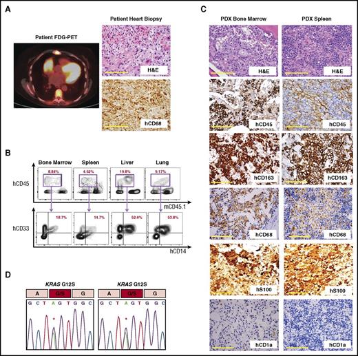 Figure 2. Analysis of a patient-derived xenograft from a KRASG12S-mutant patient with ECD. (A) Fludeoxyglucose positron emission tomography (FDG-PET) imaging and histologic and immunohistochemical analysis of the KRASG12S-mutant ECD patient’s heart biopsy specimen (scale bars represent 200 µm). (B) Flow cytometric analysis of BM, spleen, liver, and lung of recipient NSGS mouse 90 days postxenotransplantation with CD34+ cells from the same KRASG12S-mutant ECD patient. (C) Histologic and immunohistochemical analysis of engrafted tissue from the recipient mouse (scale bars represent 200 µm). (D) Sanger sequencing of genomic DNA from hCD45+ cells purified from recipient mouse BM (left) and spleen (right) revealing a KRASG12S mutation in engrafted human hematopoietic cells. H&E, hematoxylin and eosin.