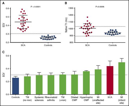Figure 2. Increased myocardial extracellular volume fraction and native T1 in sickle cell anemia. Scatterplots showing increased (A) ECV and (B) native T1 in SCA compared with normal controls. Dotted lines represent the reported lower and upper normal limits. (C) Bar graph demonstrating the mean ECV values in previously published studies of fibrotic heart diseases (shown in green),21-27 in comparison with normal controls (shown in blue) and SCA patients in this study (shown in red). Dashed line represents the upper limit of normal. CMP, cardiomyopathy; MI, myocardial infarction; TM, thalassemia major (+iron, indicates presence of myocardial iron overload).