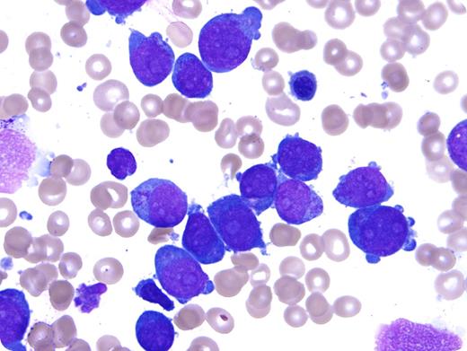 A 2-year-old girl with Down syndrome (DS) presented to the emergency department after developing easy bruising and a petechial rash on her arms, legs, and face. Her laboratory results on admission were significant for anemia and thrombocytopenia: white blood cells, 10.1 × 109/L; hemoglobin, 6.6 g/dL; hematocrit, 19.4%; mean corpuscular volume, 102.6 fL; red cell distribution width, 15.7%; and platelets, 3 × 109/L. Bone marrow aspirate smears (original magnification ×1000; Wright-Giemsa stain) revealed numerous large blasts with prominent nucleoli, deeply basophilic cytoplasm, coarse cytoplasmic granules, and frequent cytoplasmic blebbing. Flow cytometry showed that the blasts were positive for CD4, CD7, CD11b, CD13, CD33, CD34 (subset), CD36, CD38, CD45, and CD117, and negative for CD19, CD56, CD61, CD64, and HLA-DR. An immunohistochemical stain for CD31 was positive. The findings are diagnostic of myeloid leukemia associated with DS (ML-DS). / The megakaryoblastic morphology illustrated by this case is common in ML-DS. Most are positive for CD61, but some (like this case) lack CD61 while expressing other megakaryocytic markers, including CD31, CD41, and CD42b (the latter 2 were not tested in this case). Coarse cytoplasmic granules are often present in megakaryoblastic ML-DS, but are negative for myeloperoxidase and nonspecific esterase. Truncating somatic mutations of GATA1 are present in all ML-DS.