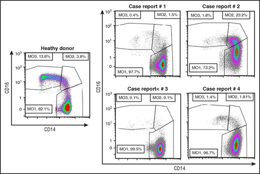 Figure 2. Monocyte subset repartition in patients with a monocytosis. Multiparameter flow cytometry analysis of monocyte (MO) subsets13 in a healthy donor and in the 4 reported cases, showing an increased fraction of classical monocytes (>94%), except in case report 2 in which an associated inflammatory disease alters the characteristic repartition.