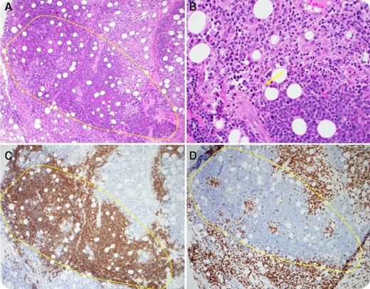 A 5-year-old girl with relapsed/refractory B lymphoblastic leukemia was treated with T cells expressing a chimeric antigen receptor (CART) targeting CD19. Preinfusion, the bone marrow was 90% involved and a computed tomography scan demonstrated extensive thoracic/abdominal/pelvic lymphadenopathy. The patient developed cytokine release syndrome (CRS) 3 days after infusion. Eight days after infusion, a soft-tissue mass involving the right eyelid and periorbital region developed. Although CRS resolved by day 11, this mass increased in size until day 18, when a biopsy was performed to determine the etiology. / Hematoxylin and eosin–stained sections (panel A; original magnification ×100) show sheets of large atypical blasts (bounded by yellow line) surrounded by a lymphohistiocytic infiltrate. Apoptosis and debris is noted at the tumor–T-cell interface (panel B, arrow; original magnification ×400) consistent with cell death. CD19 immunostain (panel C, brown; original magnification ×100) highlights B lymphoblasts, whereas CD8 immunostain (panel D, brown; original magnification ×100) highlights surrounding T cells. The mass regressed shortly after biopsy without further intervention. A subsequent bone marrow biopsy demonstrated morphologic remission. These findings are consistent with delayed but active tumor cell killing by CART cells.