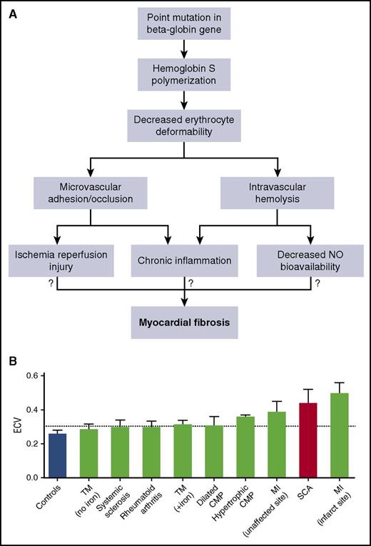 Myocardial fibrosis: a concerning finding without an etiology. (A) Despite the “simple” point mutation and hemoglobin S formation that underlies SCD, there are numerous adverse cellular and biochemical changes. Hemoglobin S polymerization leads to decreased erythrocyte deformability and eventually microvascular occlusion and intravascular hemolysis. Both microcirculatory occlusion and intravascular hemolysis act in concert to cause tissue ischemia-reperfusion injury, chronic inflammation, and decreased NO bioavailability. We do not know which abnormality, if any, leads to myocardial fibrosis. (B) ECV quantification in SCD is exceeded only by ECV quantification at the site of infarcted myocardium. CMP, cardiomyopathy; SCA, sickle cell anemia; TM, thalassemia major (+iron, indicates presence of myocardial iron overload). See Figure 2C in the article by Niss et al that begins on page 205.
