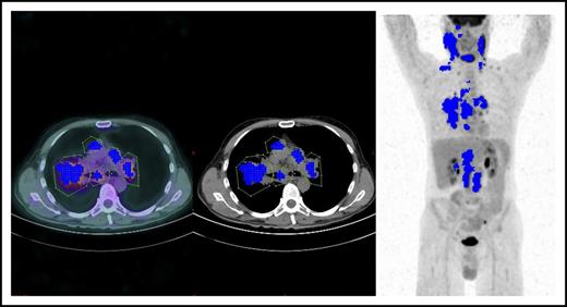 Tumor segmentation in an HL patient showing 5 sizeable mediastinal lymph nodes (courtesy of Salim Kanoun).