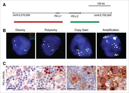 Figure 3. Genetic and immunohistochemical analyses of the PD-L1 and PD-L2 loci. (A) Location and color-labeling of the BAC clones on 9p24.1 used for FISH. RP11-599H20 including PD-L1, labeled red. RP11-635N21 including PD-L2, labeled green. (B) Representative images of FISH results for the different categories. PD-L1 in red, PD-L2 in green, fused (F) signals in yellow and centromeric probe (CEP9) in aqua (A). In these images, disomy reflects 2A:2F; polysomy, 3A:3F; copy gain, 3A:6F; and amplification, 15+F. (C) PD-L1 (brown)/PAX5 (red) immunohistochemistry in the cHL cases with 9p24.1 disomy, polysomy, copy gain, and amplification from panel B. Scale bar indicates 50 μm. Reprinted with permission © (2016) American Society of Clinical Oncology. All rights reserved. Roemer, MG et al: J Clin Oncol Vol. 34 (23), 2016 2690-7.