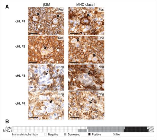 Figure 4. β2M, MHC class I, and MHC class II expression in cHL patients. (A) β2M and MHC class I immunohistochemical staining in 4 representative cHL patients: #1, positive for both markers (Pos); #2, decreased for both markers (Dec); #3 and #4, negative for both markers (Neg). Individual HRS cells are depicted with a black arrow. The white arrows indicate expression on surrounding, nonmalignant inflammatory cells. Scale bar, 50 μm. (B) Heat map representing the distribution of β2M and MHC class I (MHC-I) expression in the 108 cHL patients. White, negative; gray, decreased; black, positive; hatched, not assessable (NA). Reprinted with permission from Cancer Immunology Research 2016; 4: 910.