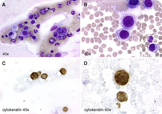 A 33-year-old woman with widely metastatic breast cancer was admitted with hemorrhagic shock and disseminated intravascular coagulation (DIC). Review of the Wright-stained peripheral blood smear showed leukoerythroblastosis, thrombocytopenia, and large atypical cells (∼50 µm) with vacuolated cytoplasm resembling myeloid/erythroblasts or Burkitt lymphoma cells. Most large cells were found at the feathered edge (panel A) and sides of the smear (panel B), with a few present at the center (panel B inset, original magnification ×40). Given the patient's history, these findings were suspicious for carcinoma cell leukemia/carcinocythemia. Immunohistochemistry for cytokeratin was positive in the suspect cells, confirming the diagnosis (panels C-D). Despite supportive care, she developed worsening coagulopathy and died shortly thereafter before a bone marrow biopsy or ancillary studies could be obtained. / Carcinocythemia mimics leukemia and is an unusual finding in a peripheral blood smear. This phenomenon may be attributable to impaired clearance by the reticuloendothelial system due to tumor infiltration or to deteriorated immune surveillance. Curiously, it appears to occur independent of bone marrow infiltration. Reported cases have been associated with DIC/thrombosis, suggesting its causative role in thrombotic disorders. Carcinocythemia differs from cancer cells present in minute amounts in the bloodstream (circulating tumor cells) that can only be detected by immunological, molecular, or functional assays.