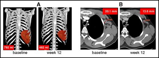 Figure 6. Reduction of spleen volume and lymph node size. Representative reduction of (A) an enlarged spleen (patient 1) and (B) lymph node (left axillary lymph node in patient 2). Up to 6 enlarged lymph nodes were identified at baseline and sizes were compared pre- and posttreatment.