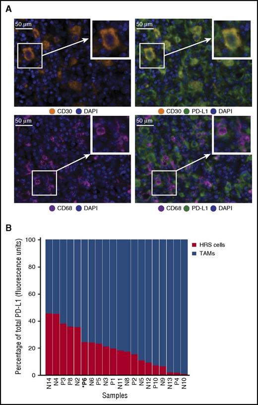 Figure 1. Expression of PD-L1 by HRS cells and TAMs. (A) Multiplex IF staining (40× resolution, case P6) for CD30 (top left, orange) to highlight HRS cells, CD68 (bottom left, magenta) to highlight TAMs, and PD-L1 (green) to show colocalization of PD-L1 and CD30 (top right, colocalization, yellow) and PD-L1 and CD68 (bottom right). Each image includes a nuclear counterstain/4′,6-diamidino-2-phenylindole (blue). (B) The relative amount of total PD-L1 per tumor (calculated as percentage of total fluorescence units), contributed by HRS cells (red) and TAMs (blue). The cases are ordered by the percentage of PD-L1 attributed to HRS cells, from highest to lowest. Cell lineage assignments (HRS cell; TAM) are based on pathologist-trained algorithms and include data from all fluorescent-channels (“Methods”). DAPI, 4′,6-diamidino-2-phenylindole.