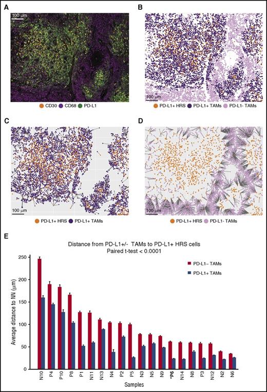 Figure 2. Distances from PD-L1+ TAMs and PD-L1−TAMs to the nearest PD-L1+ HRS cells. (A) Representative multiplex IF image (20× resolution; case P6) showing staining for CD30 (orange), CD68 (magenta), and PD-L1 (green). (B) Cellular phenotype map of the image shown in A depicting locations of PD-L1+ HRS cells (orange dots), PD-L1+ TAMs (purple dots), and PD-L1− TAMs (pink dots). (C) Ray plot depicting the distance from each PD-L1+ TAM to the nearest PD-L1+ HRS cell. (D) Ray plot depicting the distance from each PD-L1− TAM to the nearest PD-L1+ HRS cell. (E) The mean distances (microns) and standard errors for all 20 study tumors, divided into mean distance from PD-L1− TAMs to the nearest PD-L1+ HRS cells (red) and mean distance from PD-L1+ TAMs to the nearest PD-L1+ HRS cells (blue). The tumors are ordered by the distances from PD-L1− TAMs to PD-L1+ HRS cells, from highest to lowest. P value (<.0001) was calculated by paired Student t test. NN, nearest neighbor.