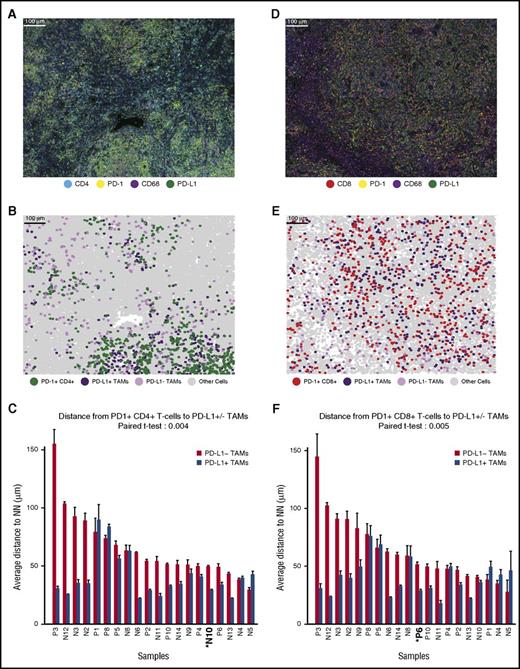 Figure 3. Distances from PD-1+ CD4+ and PD-1+ CD8+ T cells to the nearest PD-L1+ TAMs. (A) Representative multiplex IF image (20× resolution; case N10) showing staining for CD4 (cyan), PD-1 (yellow), CD68 (magenta), and PD-L1 (green). (B) Cellular phenotype map of image shown in A depicting the locations of PD-1+ CD4+ T cells (green dots), PD-L1+ TAMs (purple dots), PD-L1− TAMs (pink dots), and undefined cells (gray dots). (C) The mean distances (microns) and standard errors for all 20 study tumors, divided into mean distance from PD-1+ CD4+ T cells to the nearest PD-L1+ TAMs (blue) and mean distance from PD-1+ CD4+ T cells to the nearest PD-L1− TAMs (red). Tumors are ordered by the distance between PD-1+ CD4+ T cells and PD-L1− TAMs, from highest to lowest. P value (.004) was calculated by paired Student t test. (D) Representative multiplex IF image (20× resolution; case P6) showing staining for CD8 (red), PD-1 (yellow), CD68 (magenta), and PD-L1 (green). (E) Cellular phenotype map of image shown in D depicting the locations of PD-1+ CD8+ T cells (red dots), PD-L1+ TAMs (purple dots), PD-L1− TAMs (pink dots), and undefined cells (gray dots). (F) The mean distances (microns) and standard error for all 20 study tumors, divided into mean distance from PD-1+ CD8+ T cells to the nearest PD-L1+ TAMs (blue) and mean distance from PD-1+ CD8+ T cells to the nearest PD-L1− TAMs (red). Tumors are ordered by the distance from PD-1+ CD8+ T cells to the nearest PD-L1− TAMs, from highest to lowest. P value (.005) was calculated by paired Student t test.