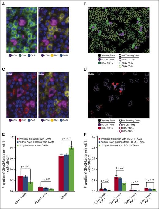 Figure 4. T-cell subsets in contact with TAMs. (A) Representative image (40× resolution; case N13) showing CD4+ T cells (left panel, green) with coexpression of PD-1 (right panel, yellow) touching CD68+ TAMs (left and right panels, magenta). (B) Membrane map depicting CD4+ T cells (PD-1+ dark green; PD-1− light green), and PD-L1+ TAMs (purple). Cells are generally only outlined, with the exceptions of PD-1+ CD4+ T cells and PD-L1+ TAMs that are in contact, which are filled to highlight the interaction. (C) Representative image (40× resolution; case N13) showing CD8+ T cells (left panel, red) with coexpression of PD-1 (right panel, yellow) touching CD68+ TAMs (left and right panels, magenta). (D) Membrane map depicting CD8+ T cells (PD-1+ dark red; PD-1− light red), and PD-L1+ TAMs (purple). Cells are generally only outlined, with the exceptions of PD-1+ CD8+ T cells and PD-L1+ TAMs that are in contact, which are filled. (E) Mean and standard error of the proportion of cells that are CD4+ T cells, CD8+ T cells, or undefined that are in contact with TAMs (red bars), within 75 µm of TAMs (blue bars), or more than 75 µm from TAMs (green bars), respectively. P values calculated by the Wilcoxon test. (F) Mean and standard error of the proportion of cells that are PD-1+ CD4+ T cells, PD-1− CD4+ T cells, PD-1+ CD8+ T cells, or PD-1− CD8+ T cells and that are in contact with PD-L1+ TAMs (red bars), within 75 µm of PD-L1+ TAMs (blue bars), or more than 75 µm from PD-L1+ TAMs (green bars), respectively. P values calculated by the Wilcoxon test.