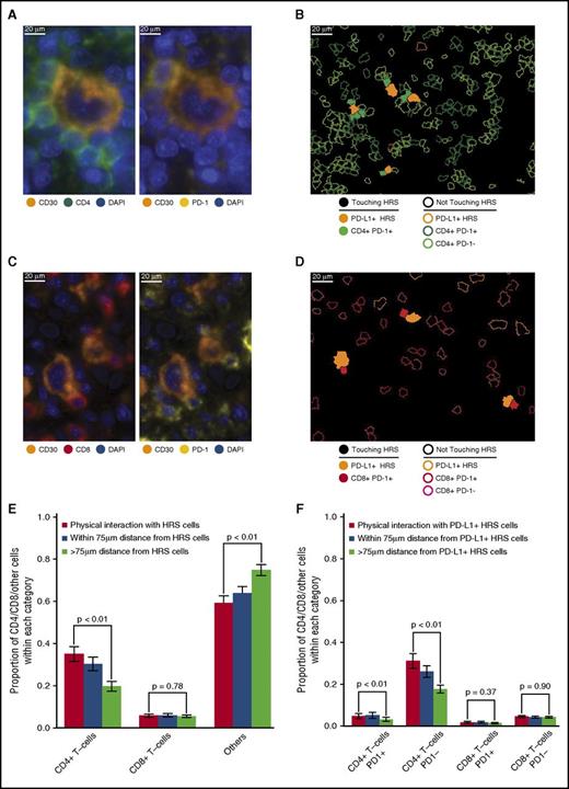 Figure 5. T-cell subsets in contact with HRS cells. (A) Representative image (40× resolution; case N12) showing CD4+ T cells (left panel, green) with coexpression of PD-1 (right panel, yellow) touching a CD30+ HRS cell (left and right panels, orange). (B) Membrane map depicting CD4+ T cells (PD-1+ dark green; PD-1− light green), and PD-L1+ HRS cells (orange). Cells are generally only outlined, with the exceptions of PD-1+ CD4+ T cells and PD-L1+ HRS cells that are in contact, which are filled to highlight the interaction. (C) Representative image (40× resolution; case P6) showing CD8+ T cells (left panel, red) with coexpression of PD-1 (right panel, yellow) touching CD30+ HRS cells (left and right panels, orange). (D) Membrane map depicting CD8+ T cells (PD-1+ dark red; PD-1− light red), and PD-L1+ HRS cells (orange). Cells are generally only outlined, with the exceptions of PD-1+ CD8+ T cells and PD-L1+ HRS cells that are in contact, which are filled. (E) Mean and standard error of the proportion of cells that are CD4+ T cells, CD8+ T cells, or undefined and that are in contact with HRS cells (red bars), within 75 µm of HRS cells (blue bars), or more than 75 µm from the HRS cells (green bars), respectively. P values calculated by the Wilcoxon test. (F) Mean and standard error of the proportion of cells that are PD-1+ CD4+ T cells, PD-1− CD4+ T cells, PD-1+ CD8+ T cells, or PD-1− CD8+ T cells in contact with PD-L1+ HRS cells (red bars), within 75 µm of PD-L1+ HRS cells (blue bars), or more than 75 µm from PD-L1+ HRS cells (green bars), respectively. P values calculated by the Wilcoxon test.