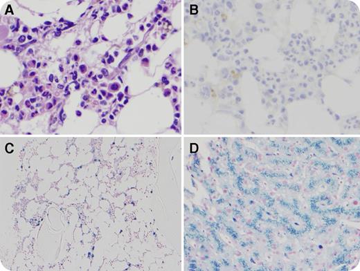 A 35-year-old man with prolonged aplasia (62 days) after 2 inductions for acute myeloid leukemia (AML), underwent a myeloablative, matched-sibling, A-to-O allogeneic stem cell transplantation. Despite rapid neutrophil and platelet recovery, he remained red blood cell aplastic (reticulocytes <1%) with a negative infectious (including parvovirus B19) and nutritional workup. A day 100 bone marrow specimen revealed absent erythropoiesis (panel A: original magnification ×50; hematoxylin and eosin stain; panel B: original magnification ×20; E-cadherin stain) and iron overload (panel C: original magnification ×10; Prussian blue stain). The anti-A isohemagglutinin immunoglobulin G titer was 1:128, and a diagnosis of pure red blood cell aplasia (PRCA) due to major ABO mismatch was established. A liver biopsy (6 months posttransplant) to investigate transaminitis (alanine aminotransferase, 462 U/L; aspartate aminotransferase, 209 U/L; alkaline phosphatase, 332 U/L) showed striking iron overload (panel D: original magnification ×20; Prussian blue stain). Ferritin and transferrin saturations at that time were 7166 ng/mL and 96%, respectively. Four weekly doses of rituximab and a taper of cyclosporine resulted in the resolution of anemia, and therapeutic phlebotomy was initiated. Since the diagnosis of AML, the patient received 60 units of packed red blood cells. / Antidonor red blood cell antibodies made by residual patient-derived plasma cells can cause PRCA after major ABO-mismatched transplant. Although adding immunosuppression (eg, rituximab) can block this process, tapering immunosuppression may be effective by generating a graft-versus-plasma cell effect.