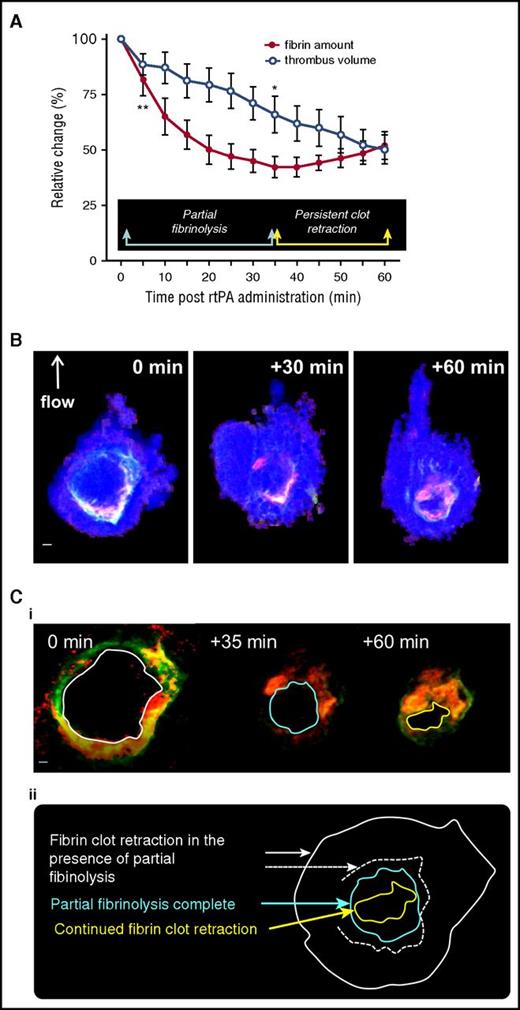 Figure 4. Limited fibrinolysis promotes clot retraction. (A) rtPA was administered onto partly retracted thrombi that were 20 minutes old. Changes to the thrombus size and fibrin amount were quantified over the next 60 minutes and data expressed as a percentage of values at t = 5 minutes. Results depict the mean ± SEM (n = 8), where *P < .05 and **P < .01 by 1-way ANOVA with Tukey correction. (B-C) Confocal maximum intensity projection of platelets (B; Dylight 649 anti-mouse GP1bα antibody; blue), fibrin (Alexa Fluor 546 anti-fibrin antibody; red), and plasminogen–fluorescein isothiocyanate (FITC) (green) (B,Ci) within the same thrombus before rtPA administration (t = 0 min), after a period of overt fibrinolysis (t = +30 min) and after subsequent retraction of the unlyzed remaining fibrin network (t= +60 min). (Cii) Schematic depicts the size of the fibrin network at t = 0, 30, and 60 minutes after rtPA delivery. The direction of blood flow (B, arrow) and scale bars (B, 10 μm; Ci, 20 μm) are shown.