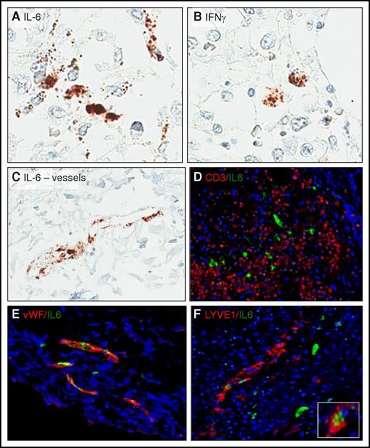 Figure 2. Cell-type source of CRS-associated cytokine in the lymph nodes. ISH was used to identify cells expressing IL-6 (A,C) and interferon-γ (B). (D) Lack of IL-6 (green) and CD3 (red) colocalization indicates that T cells/CARTs are not the source of IL-6. (E) Colocalization of IL-6 (green) with von Willebrand factor (vWF; red) expressed by blood vessel endothelium and (F) lymphatic vessel endothelial antigen 1 (LYVE1; red) confirms that endothelial cells, in particular blood vessel endothelial cells, are the key source of IL-6 in CRS. Inset: high-power view of the double-positive endothelial cells.