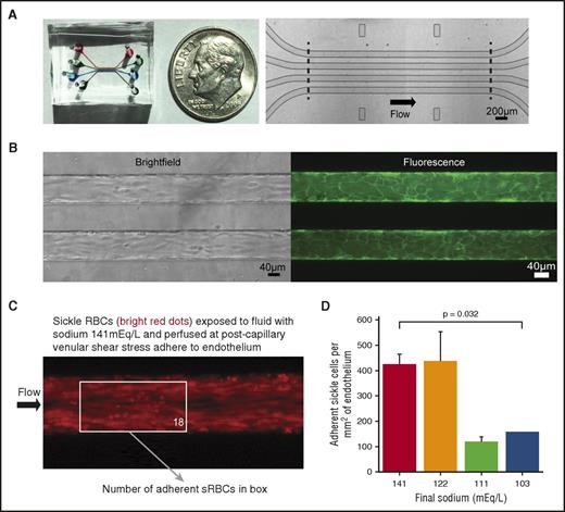 Figure 4. Sickle red blood cells exposed to lower sodium fluids are less adherent to human endothelium under postcapillary venular shear stress. (A) Macroscopic (left) and microscopic (right) images of the 4-chamber microfluidic device, whereby 4 lanes with separate inlets and outlets are each 46 µm tall, 100 µm wide, and 4 mm in length along the uncurving portion of the device. (B) Brightfield (left) and fluorescence (right, membrane dye) microscopy images of the microfluidic device endothelialized to confluence. (C) Fluorescence images of stained sRBCs adhered to human umbilical vein endothelial cells. sRBCs exposed to fluids with higher sodium levels adhere to endothelium under a postcapillary venular shear stress of 1 dyne/cm2. (Boxed number corresponds to number of sRBCs adherent to endothelium in that region of interest.) (D) In total, sRBCs were isolated from 6 patients. sRBCs were less adherent when exposed to the most hypotonic admixtures. Bars and lines represent mean ± standard deviation from 3 patients for each experimental condition, except the most hypotonic (N = 2).