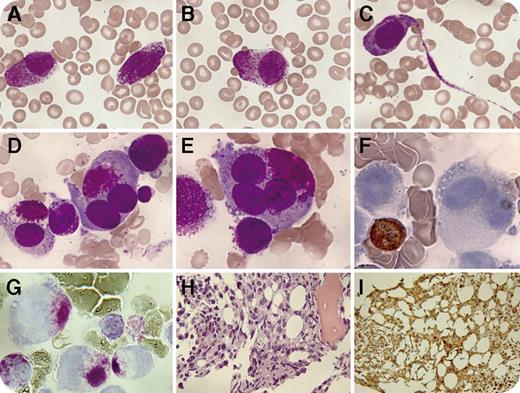 A 39-year-old woman presented with severe low back pain, hepatosplenomegaly, leukocytosis (15.9 × 109/L), anemia (7.3 g/dL), thrombocytopenia (48 × 109/L), and elevated serum tryptase (>200 ng/mL). Coagulation was normal. Blood film revealed 46% promyelocyte-like cells (panel A; original magnification ×1000; May-Grünwald-Giemsa stain), with a few cells showing focal granule accumulation (panel B; original magnification ×1000; May-Grünwald-Giemsa stain). A cytoplasmic projection was detected in up to 2% of these cells (panel C; original magnification ×1000; May-Grünwald-Giemsa stain). Marrow aspirate showed 88% hypergranular cells, many of them with multilobed nuclei and pronounced polar granule aggregates (panels D-E; original magnification ×1000; May-Grünwald-Giemsa stain). No Auer rods were found. These cells showed myeloperoxidase negativity (panel F; original magnification ×1000) and metachromasia on toluidine blue staining (panel G; original magnification ×1000). Flow cytometry identified the cells as CD203c+/CD117++/CD123−/CD45+/CD33++/CD13+/HLADR−/CD2−/CD25−/CD30+. Trephine biopsy showed diffuse infiltration (panel H; original magnification ×250, hematoxylin and eosin stain) by CD117+/CD25−/tryptase+ cells (panel I; original magnification ×200, tryptase immunostain). Cytogenetics revealed a complex karyotype (55-86 chromosomes) with numerous marker chromosomes. PML/RARA rearrangement and KIT D816V mutation were negative. A diagnosis of mast cell leukemia (MCL) was made. Sixty-four days later, the patient died of multiorgan failure. / Circulating hypergranular neoplastic cells are observed in “typical” acute promyelocytic leukemia. However, MCL, an aggressive and very rare form of systemic mastocytosis, should also be considered. A negative KIT D816V result does not exclude MCL. Tryptase levels and immunophenotype ease the diagnosis.