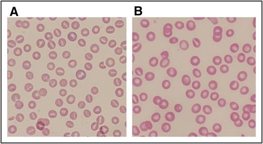 Figure 2. Peripheral blood smears from patients with abnormalities of erythrocyte volume homeostasis. (A) A Wright-stained peripheral blood smear (original magnification ×40) from a patient with hereditary hydrocytosis is shown. Numerous stomatocytes, erythrocytes with a central mouthlike or “stoma” appearance, are seen. (B) A Wright-stained peripheral blood smear (original magnification ×40) from a patient with HX showing rare stomatocytes, dessicytes, which are dense, abnormal erythrocyte forms where hemoglobin appears puddled at the periphery, and target cells.