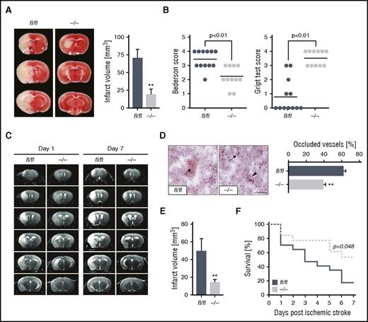 Figure 7. Ck2β−/− mice are protected from ischemic stroke in vivo and display less thrombotic cerebral vascular occlusions with a significantly better neurological outcome and survival after stroke. (A) Representative images of 3 corresponding coronal sections of 2,3,5-triphenyltetrazolium chloride–stained brains from ck2βfl/fl and ck2β−/− mice 24 hours after tMCAO (left). Arithmetic means ± standard errors of the mean (n = 11-12) of brain infarct volumes in ck2βfl/fl (blue bar) and ck2β−/− mice (gray bar) 24 hours after tMCAO (right). (B) Bederson score reflecting global neurological defects (0 indicates best, 5 indicates worst; left) and grip test indicating motor functional and coordination deficits (0 indicates worst, 5 indicates best; right) assessed 24 hours after tMCAO. Each dot represents 1 individual mouse. (C) Representative coronal T2-weighted magnetic resonance imaging images of hyperintense ischemic brain infarct lesions of ck2βfl/fl and ck2β−/− mice at day 1 and day 7 (infarct maturation) after tMCAO (n = 3-7/group). Hypointense areas (reflecting intracerebral hemorrhage) were not observed. (D) Determination of thrombosis index by quantification of thrombotic occluded vs nonoccluded vessels within the ischemic hemisphere 24 hours after tMCAO. Arithmetic means ± standard errors of the means (n = 5, right) and representative images (left) of H&E-stained cryosections are shown. Bar represents 100 μm. (E) Arithmetic means ± standard errors of the means (n = 6) of infarct volume in ck2βfl/fl and ck2β−/− mice 7 days after tMCAO (infarct maturation). (F) Analysis of survival of ck2βfl/fl (blue line) and ck2β−/− (gray line) mice 7 days after ischemic stroke (n = 13-17). Student t test in panels A-D and log-rank (Mantel-Cox) analysis in panel F. **P < .01.