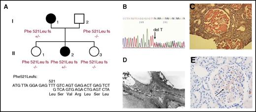 Figure 1. Novel amyloidogenic “private” Aα-chain frameshift variant in a French family. (A) The family pedigree of the AFib-kindred with familial segregation of the Phe521Leufs variant because of a single thymine deletion at Phe521. Squares denote male family members; circles, female family members; and solid symbols, affected family members. (B) Partial sequence of FGA exon 5 from II.2, indicating heterozygosity for deletion of a single thymine leading to superimposed sequences after codon 521. (C) Congo red deposits in the glomeruli of renal specimens from II.2 (original magnification ×400). (D) The amyloid fibrils found in the mesangium and under the glomerular basement membrane, appearing as straight unbranched fibrils with 10 nm diameter by electron microscopy (original magnification ×1400). The asterisk indicates the fibrils. (E) Positive staining with the specific Aα-chain antibody raised against the C-terminal Aα-chain mutant sequence (black arrow).