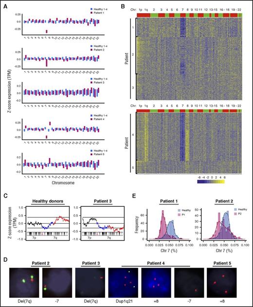Figure 2. Detection of CNVs in single cells from patients. (A) Average gene expression for each chromosome in single cells from patients and healthy donors. Average gene expression levels of individual chromosomes from 4 healthy donors were used for comparison. Chromosome mapping read values were median-centered. The top and bottom of the bar represent the 25% and 75% quartiles. (B) Heatmaps of CNV signals obtained by sliding window analysis. scRNA-seq data of patients were normalized against those of healthy donors. Copy-number changes were examined in 22 chromosomes (columns) for patients’ individual cells (rows). (C) CNV signals on chromosome 7 obtained from healthy donors and patient 3 by sliding window analysis. Two black lines show 95% confidence intervals. 7q11-21 and 7q22-36 are indicated in blue and red, respectively. (D) Cytogenetic abnormalities detected by fluorescence in situ hybridization. Probes used to detect specific chromosomes were: CDKN2C and CKS1B for chromosome 1, CEN 8 for chromosome 8, and CEN7 and D7S486 for chromosome 7. (E) Histograms of read ratios on chromosome 7 in patients 1 and 2. Pink, cells from patients; blue, cells from healthy donors; purple, distribution overlap between each patient and healthy donors; y-axis, frequency of cell number; and x-axis, ratios of reads on chromosome 7 in individual cells relative to reads on all chromosomes in the same cell.