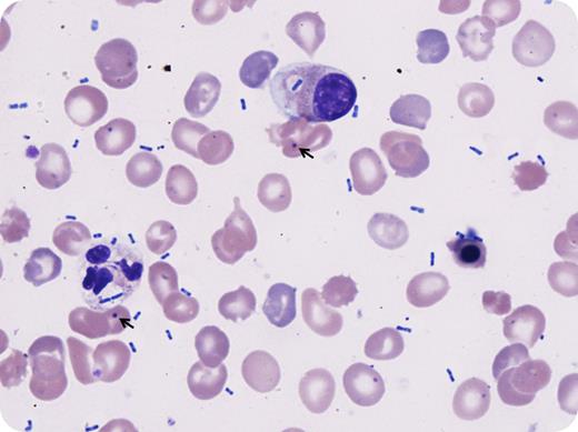 A 24-year-old man presented to the emergency room with respiratory distress and altered mental status. He had a past medical history of pyruvate kinase deficiency with status postsplenectomy at 6 years of age. On examination, he was hypotensive and febrile; he was intubated on admission. Workup showed macrocytic anemia, leukocytosis, and slight neutrophilia, with elevated lactate, prothrombin time, and activated partial thromboplastin time, mixed respiratory and metabolic acidosis, and hypoxemia. Chest radiograph demonstrated dense bilateral pulmonary infiltrates. Peripheral blood smear showed leukoerythroblastosis with left-shifted granulocytes exhibiting toxic morphology and numerous extracellular and intracellular bacilli (Wright stain; original magnification ×100). Additional findings compatible with asplenic status were also noted, including numerous nucleated red blood cells, Pappenheimer bodies, and Howell-Jolly bodies (arrows). Despite broad-spectrum antibiotics, supportive care, and multiple vasopressors, he remained in intractable septic shock and unfortunately died. Blood cultures grew Klebsiella pneumoniae that was pan-sensitive. / Asplenic patients lack splenic macrophages necessary for eliminating opsonized encapsulated organisms. Prophylactic vaccination, particularly with pneumococcal vaccine (which the patient had received), is important to prevent some life-threatening infections in asplenic patients. However, vaccination is currently unavailable for K pneumoniae and it remains one of the common causes of these rare, overwhelming, and rapidly life-threatening infections in patients who are splenectomized for congenital hemolytic anemias.