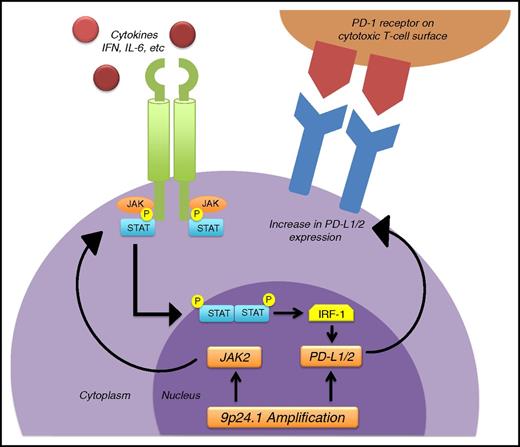 Schematic showing the mechanism of upregulation of PD-L1/2, responsible for the efficacy of the anti–PD-1 antibody pembrolizumab in primary mediastinal large B-cell and in Hodgkin lymphoma. Chromosome 9p24.1 amplification occurs commonly in these 2 disorders, leading to increased production of PD-L1/2, which in turn leads to overexpression of PD-L1/2 on the surface of the malignant cells. Another contributor to overexpression of PD-L1/2 is the JAK-STAT pathway, which when activated by different cytokines, such as interferon-γ (IFN-γ), or by overproduction of JAK2, can induce the transcription of genes that include the interferon regulatory factor 1 (IRF-1), which binds to the PD-L1/2 promoter and induces transcription and surface expression of PD-L1/2. When PD-L1/2 on the lymphoma cell surface binds with PD-1 receptor on the cytotoxic T cells, it suppresses the capacity of the immune system to attack the tumor by inactivating cytotoxic T cells. Pembrolizumab, an anti–PD-1 antibody, blocks the inactivation of the cytotoxic T cells and induces remissions mediated by the immune system. IL-6, interleukin 6.