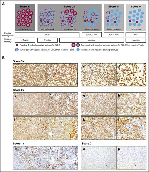 Figure 1. Scoring of BCL2 staining by pathologists. (A) The schema of the BCL2 IHC scoring based on the pattern, positive cell ratio, and intensity. *The staining intensity of all tumor cells. (B) Representative images of the BCL2 expression in DLBCLs. BCL2 protein expression by IHC in representative cases is shown at ×20 objective (left) and at ×40 objective (right). A BCL2 score of 3+ without a BCL2 rearrangement (a-b) and with a BCL2 rearrangement (c-d) by FISH analysis. Variable staining patterns of the cases with a BCL2 score 2+ (e-l). Note that compared with the score of 3+, the cytoplasmic staining intensity of the tumor cells was not uniformly strong. A BCL2 score of 1+ corresponded to negative staining in the majority of the tumor cells, and only weak positive staining in a small number of the tumor cells (m-n). A BCL2 score of 0 corresponded to only T-cell staining (o-p).