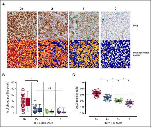 Figure 2. Correlation analysis between the pathologist’s IHC scores for BCL2 staining and the quantified values obtained by image analysis. (A) A digital slide image is shown for the BCL2 IHC each for score 3+ to 0 (top). The bottom figure is the corresponding artificial image produced with the positive pixel count algorithm (PPC). The positive brown DAB (3,3′-diaminobenzidine) staining is colored according to the level of pixel intensity with red (strong), orange (medium), yellow (weak), and blue (negative, nuclear counter stain). The thresholds for the weak, medium, and strong intensities of staining were set as defaults. Because BCL2-positive reactive T cells are always admixed in the tumor areas, these small T cells are manually selected and separated from the large tumor cells in each ROI, and the total sum of these individual areas are evaluated, respectively. Clusters of large tumor cells and individual small T cells are manually delineated by the gray lines and light blue circles, respectively. (B) In each ROI, the number of strong-positive pixels was automatically counted, and the percentage of total number of positive-staining pixels was plotted. The box and plots show the distribution of the percentage. The median values of the score of 3+ group showed a significantly higher than the score of 2+ group (P < .0001, Mann-Whitney U test for pairwise comparison with Bonferroni correction), whereas no significant difference was observed among score 0 to 2+ groups. The horizontal line within the box indicates the median value, and the lower and upper portions indicate the 25% and 75% interquartile range, respectively. The error bars represent the 5% and 95% quantiles. (C) To evaluate the staining intensity of the tumor cells, the average intensity values of the tumor cells are compared after normalization to the T cells. The intensity ratio (tumor/normal T cell) was plotted; a significant positive trend was observed for the tumor staining intensity levels with the IHC score groups (P < .0001, respectively, Mann-Whitney U test for pairwise comparison with Bonferroni correction). *Statistically significant; NS, not significant.
