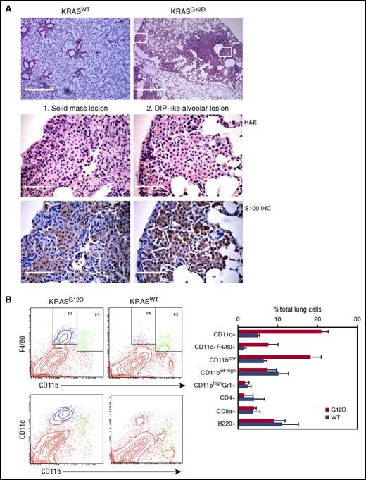 Figure 1. Characterization of hematopoietic cells accumulating in the AdCre/KRASG12D lung. (A) Histological analysis of the AdCre/KRASG12D lung. Top, low magnification images of H&E-stained lung sections from AdCre/KRASWT and AdCre/KRASG12D mice at 4 months following nasal delivery of AdCre. Scale bar, 0.5 mm. Middle and bottom, high magnification images of H&E staining (middle) and S100 IHC (bottom), corresponding to the areas indicated in the top right image of the AdCre/KRASG12D lung (left, solid mass lesion; right, DIP-like alveolar lesion). Scale bar, 62.5 μm. (B) Flow cytometry analysis of hematopoietic compartments in the AdCre/KRASG12D lung in comparison with AdCre/KRASWT controls. Representative contour plots for CD11b-F4/80 and CD11b-CD11c staining are indicated in the left, and the right bar graph summarizes the percentage of each hematopoietic population in total lung cells. The distribution of CD11blowF4/80+ (blue) and CD11bint-highF4/80+ (green) cells are indicated in CD11b-CD11c plots in the bottom left. The data in the right bar graph represent mean + standard deviation (SD) (n = 3). WT, wild type.