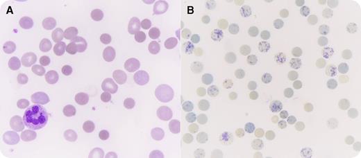 A 47-year-old white woman, who was an active smoker, was referred to the emergency department for the recent onset of exertional dyspnea with chest pain. She did not have a remarkable medical history or family history of anemia and received no medications, although she took pain medication occasionally. Her clinical examination revealed pallor and conjunctival jaundice with mild hepatosplenomegaly. She displayed isolated macrocytic (mean corpuscular volume, 125 fL) anemia (hemoglobin, 4.2 g/dL). An elevated automated reticulocyte count (603 × 109/L) was confirmed by supravital staining with brilliant cresyl blue (panel B; many cells display a typical blue-stained reticulum, original magnification ×1000). Hemolysis was confirmed (lactate dehydrogenase, 2866 IU/L; bilirubin, 62 µmol/L; haptoglobin, <0.1 g/L). The direct antiglobulin test (DAT) was originally negative, however, the examination of the blood smear showed numerous spherocytes (panel A; May-Grünwald–Giemsa stain shows sphere-shaped erythrocytes, original magnification ×1000) that looked consistent with autoimmune hemolytic anemia (AIHA) in the absence of a familial hemolysis history. Hence, a new extensive DAT was performed and revealed the presence of erythrocyte-bound immunoglobulin A (IgA) autoantibodies. Additional exploration revealed chronic nonactive hepatitis C. The severe AIHA was treated with corticosteroids, rituximab, azathioprine, and eventually responded to splenectomy. / Such DAT-negative AIHAs remain rare (∼3%-5% of all AHAIs). Warm IgA antibody AIHAs represent 1% to 2% of all warm AIHAs. This case highlights the relevance of careful blood-smear examination, which can avoid costly investigation of unexplained hemolytic anemia.
