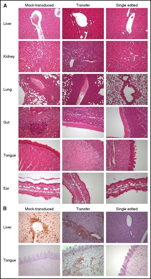 Figure 7. SE abates the risk of organ infiltration by NY-ESO-1 redirected T lymphocytes. (A) Hematoxylin-eosin staining of formalin-fixed, paraffin-embedded mouse tissues (liver, kidney, lung, gut, tongue, and ear) from 3 representative animals treated with mock-transduced (left column), transferred (middle column), and SE (right column) cells, respectively. Human lymphocytes displayed larger size when compared with their, albeit minimally present, animal counterpart. Liver involvement occurred mainly under the form of lymphocytic collections around major vessels as well as intraparenchimal nodules of variable size. In the kidney, along with perivascular arrangement, a periglomerular involvement was also encountered. Pulmonary localization was mainly around major vessels and peribronchial in a smaller proportion. In gut and ear, human lymphocytes occurred mostly under the form of few, scattered cells with subepithelial location. Interestingly, in the tongue, human lymphocytes displayed a superficial distribution, immediately beneath or exactly at dermo-epithelial junction, thus recapitulating a “graft-versus-host”–like pattern. The degree of tissue infiltration by human lymphocytes was assessed as described in “Methods” and further confirmed by immunohistochemistry with an anti-human CD3 rabbit monoclonal antibody (B). All pictures were taken at ×200 original magnification.