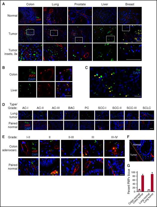 Figure 1. PMP infiltration in solid tumors in human patients. (A) Tissue microarray slides containing 5-μm sections from the indicated human tumors and uninvolved adjacent tissue (“Normal”) were stained with the indicated antibodies and 4′,6-diamidino-2-phenylindole (DAPI). Colon, grade I-II colon carcinoma; lung, grade II lung squamous cell carcinoma; prostate, grade II prostate adenocarcinoma; liver, grade II-III hepatocellular carcinoma; breast, grade II-III invasive ductal carcinoma. αIIb integrin, green; VWF, red; DAPI, blue. Bottom row, center area insets, original magnification ×3. Bars, 50 μm (n = 4). (B) Representative images from panel A, showing counterstain with fluorescein isothiocyanate (FITC)-Annexin V (AXV; shown as red). αIIb integrin, green; DAPI, blue. Merged images with DAPI shown to the right; αIIb integrin/Annexin V overlap appears as yellow. VWF staining was omitted from the merged images for clarity. (C) A section of human lung adenocarcinoma, grade II was incubated with 103 freshly isolated murine platelets for 15 minutes before being fixed and stained as indicated. Yellow arrowheads indicate ectopic intact platelets. (D) Representative images from human lung cancer array with paired uninvolved tissue, stained as in panel A. (E) Representative images from human colon cancer array with paired uninvolved tissue. Note that some αIIb integrin-positive platelets can be seen within VWF-labeled blood vessels. (F) Representative image of colon adenocarcinoma, grade III, including adjacent normal tissue, showing PMP infiltration in the uninvolved tissue adjacent to the tumor border (indicated with a dotted line). Bars (B-F), 25 μm. (G) Percentage of PMP+ tissues from total assayed tissues for colon adenocarcinomas and lung cancers, and adjacent uninvolved tissue, shown ± standard error of the mean (SEM) (n = 3). Colon, P < .01; lung, P < .004. AC, adenocarcinoma; BAC, bronchioalveolar carcinoma; PC, papillary carcinoma; SCC, squamous cell carcinoma; SCLC, small cell lung cancer.