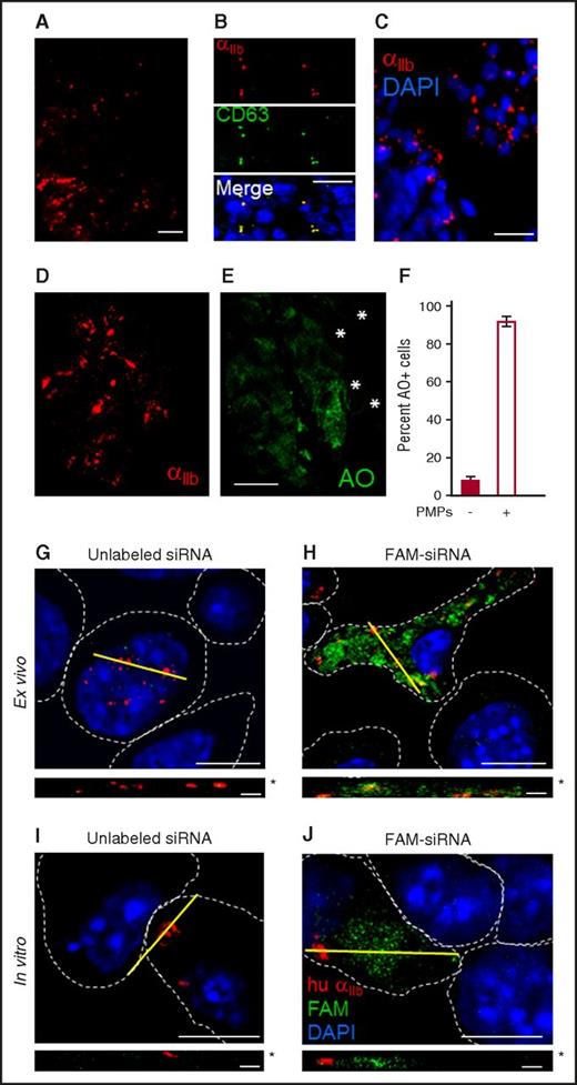 Figure 2. PMP infiltration in solid tumor allografts and RNA transfer in mice. (A) Immunohistochemistry (IHC) in a 5-μm section from LLC tumor allograft, 21 days. αIIb integrin, red. (B) IHC in a 5-μm section from LLC tumor allograft, 21 days. αIIb integrin, red (top); CD63, green (middle); DAPI, blue (shown in merged image, bottom). αIIb integrin/CD63 overlap appears in some areas in the merged image as yellow. (C) Tumor cells from a resected LLC tumor at 21 days, isolated as described in supplemental Methods. αIIb integrin, red; DAPI, blue. (D-E) Tumor cells from resected LLC allograft 24 hours after transfusion of AO-labeled platelets. (D) αIIb integrin, red; (E) AO, green. Bars (A-E), 10 μm. *PMP− cells. (F) Percentage of cells with cytosolic AO staining, shown ± SEM (n = 3, >100 cells each). (G) Human platelets were transfected with unlabeled siRNA and transfused into mice bearing 20-day LLC tumors. After 24 hours, tumors were resected, digested, cleared of vascular cells with α-CD31 beads, and tumor cells were captured on fibronectin-coated coverslips. (H) Tumor cells ex vivo as in panel G, from mice transfused with human platelets transfected with FAM-siRNA. (I) LLC cells, treated in vitro with PMPs derived from human platelets 48 hours after platelet transfection with unlabeled siRNA. (J) Cells treated as in panel I with PMPs derived from human platelets transfected with FAM-siRNA. (H-J) Human αIIb integrin, red; FAM, green; DAPI, blue. Dashed white lines indicate cell borders as determined from accompanying brightfield images (not shown). Yellow lines indicate x–y plane of z-section. Corresponding z-sections are shown below, minus DAPI stain. Bars (G-J), 7.5 μm; z-stack bars, 1 μm. Asterisks in panels G-J denote apical side of z-section.